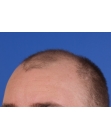 Before Hair Transplant&nbsp;Front